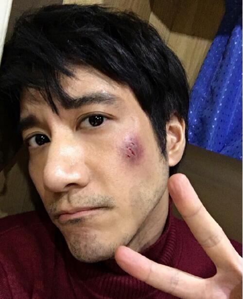 王力宏遭暴打脸部受伤 忘了说今天是四月一号了